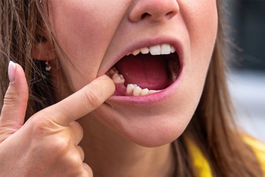 Woman pulling lip back to reveal a missing tooth