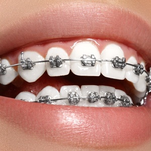 Traditional Braces Belmont, Orthodontics